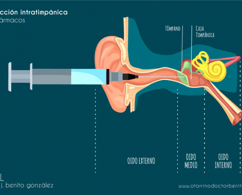 Inyección Intratimpánica - Otorrino Dr. Benito - Madrid