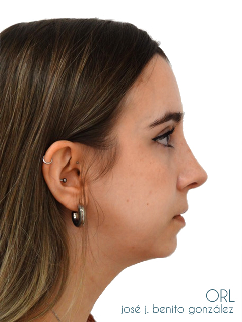 Rinoplastia Dr.Benito en Madrid Rinoplastia Dr.Benito en Madrid