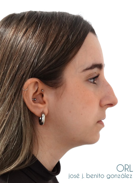 Rinoplastia Dr.Benito en Madrid Rinoplastia Dr.Benito en Madrid