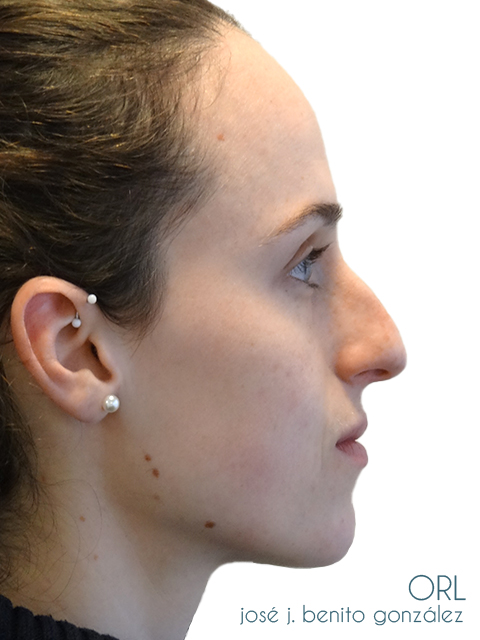 Rinoplastia Otorrino Doctor Benito - Madrid