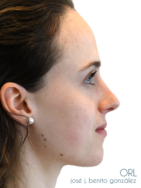 Rinoplastia Otorrino Doctor Benito - Madrid_
